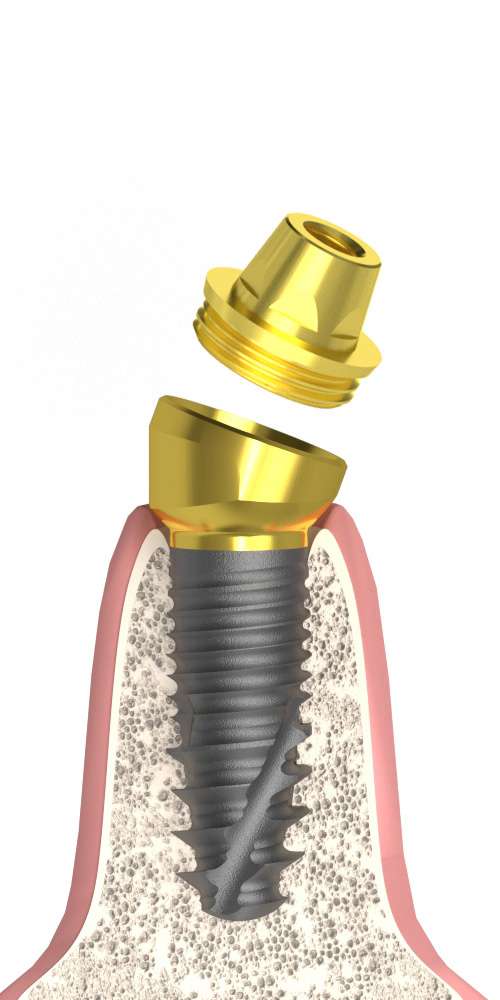Nobel® Zigoma® (ZY) Compatible, Multi-Compact abutment (MC abutment), oblique, with M1.6 multi-unit cone