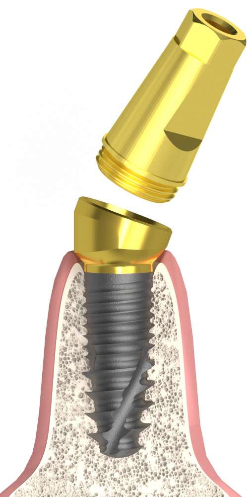 Implant Direct® InterActive® (ID) Compatible, Multi-Compact abutment (MC abutment), oblique, with a sandable head cone