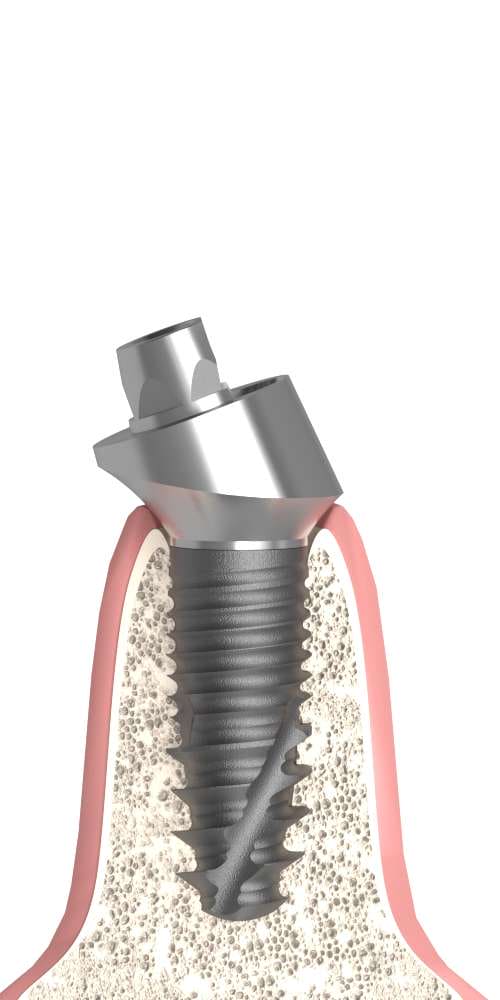 Implant Direct® Replant® (RE) Compatible, Multi-unit abutment, oblique, through-bolted