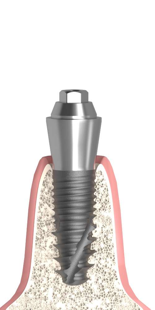 Implant Direct® Replant® (RE) Compatible, Multi-unit abutment, straight, screwable