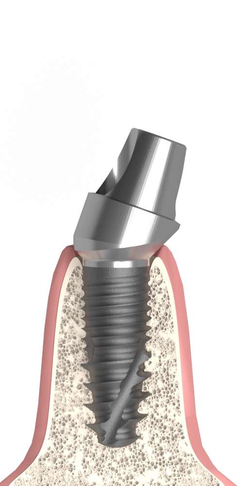 Implant Direct® InterActive® (ID) Compatible, Multi-unit SR abutment, oblique, positioned