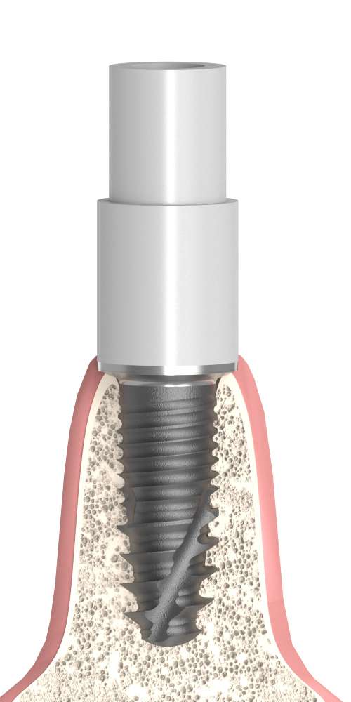 Oralplant® (OR) Compatible, Multi-unit SR abutment plastic cap, titan based, positioned