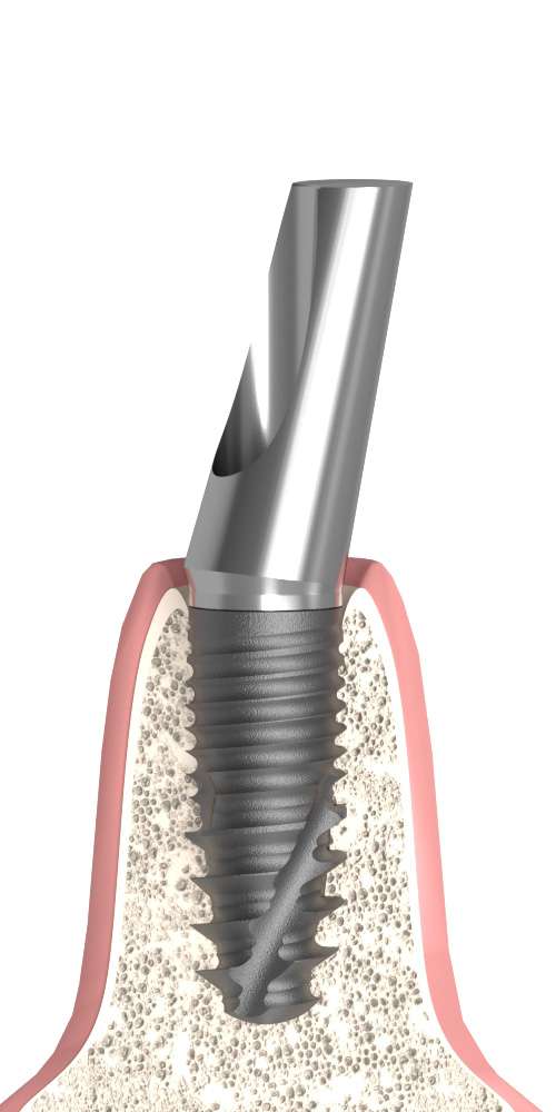 Dentum, Narrow abutment, oblique