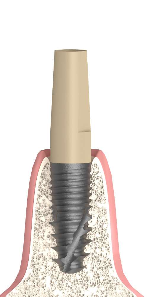 Implant Direct® Replant® (RE) Compatible, Narrow abutment, straight, PEEK
