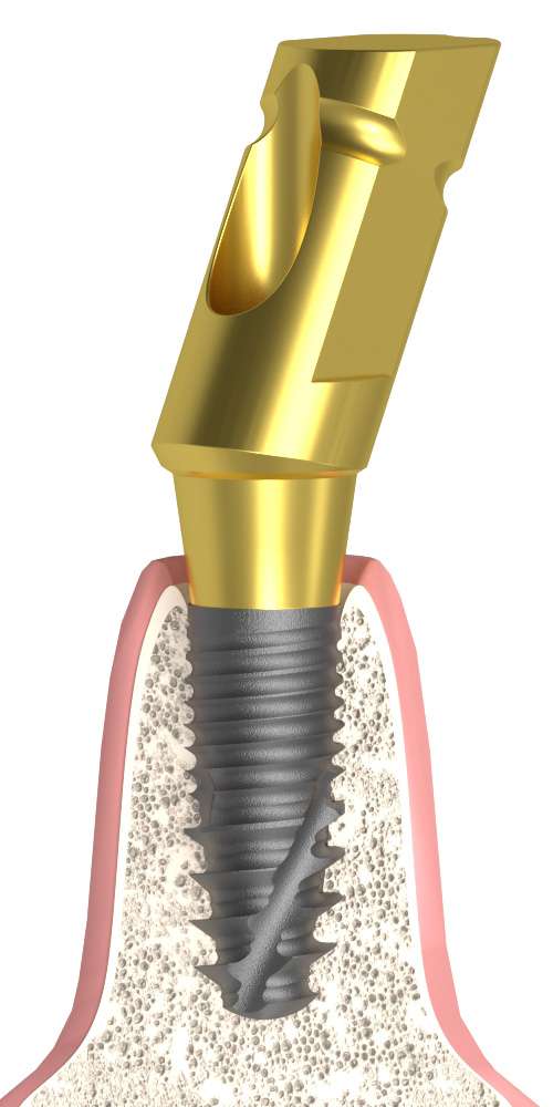 Oralplant® (OR) Compatible, Impression coping for closed tray, oblique
