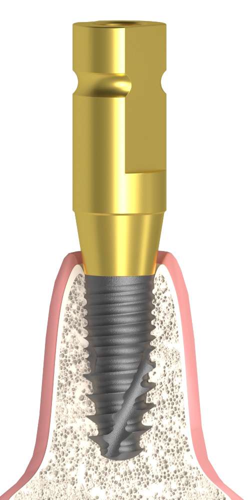 Dentum, Impression coping for closed tray, parallel