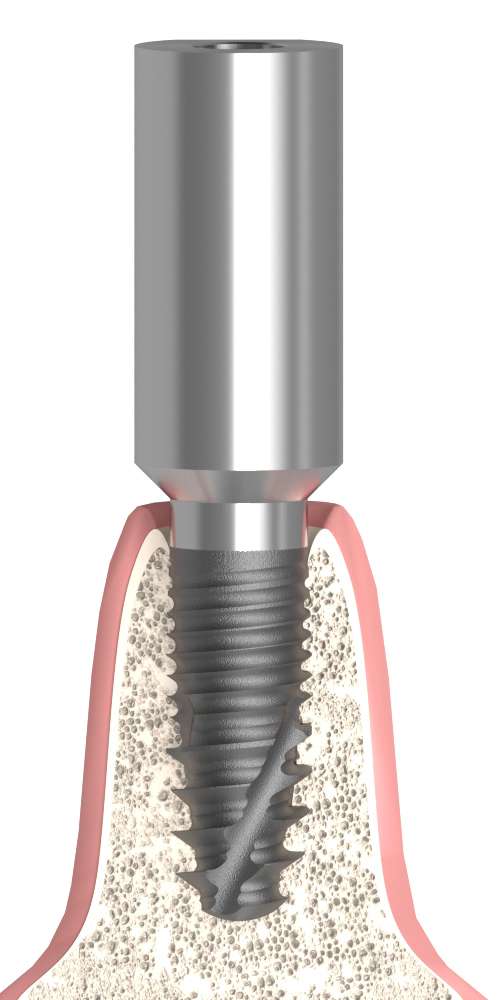 Dentum, Scan body, through-bolted, positioned