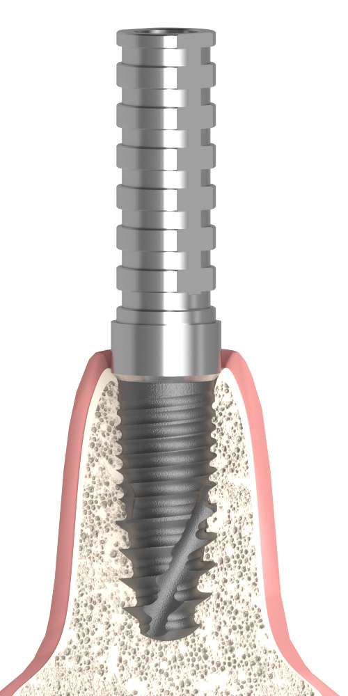 Anonym (unknown brand) (ANONYM) Compatible, Temporary abutment, implant level