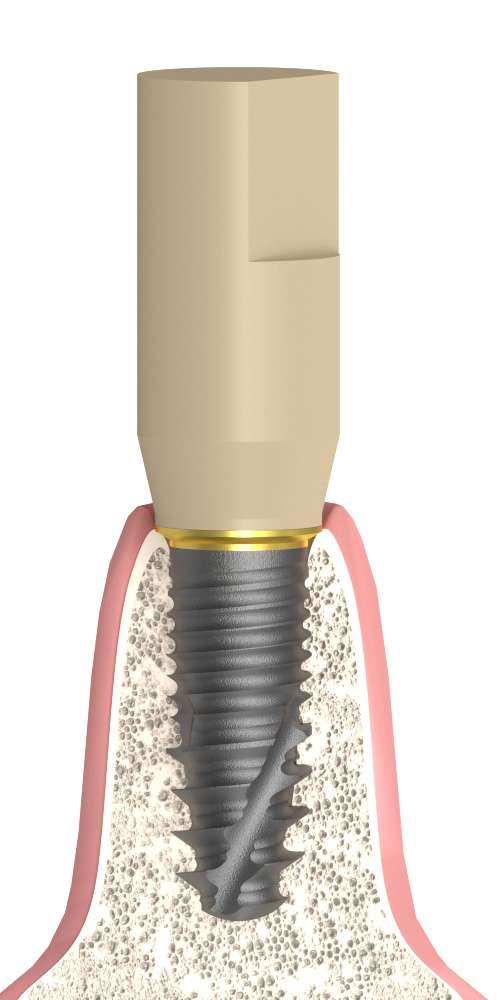 Implant Direct® InterActive® (ID) Compatible, Titanium base, Scan body, PCT stepped, PEEK