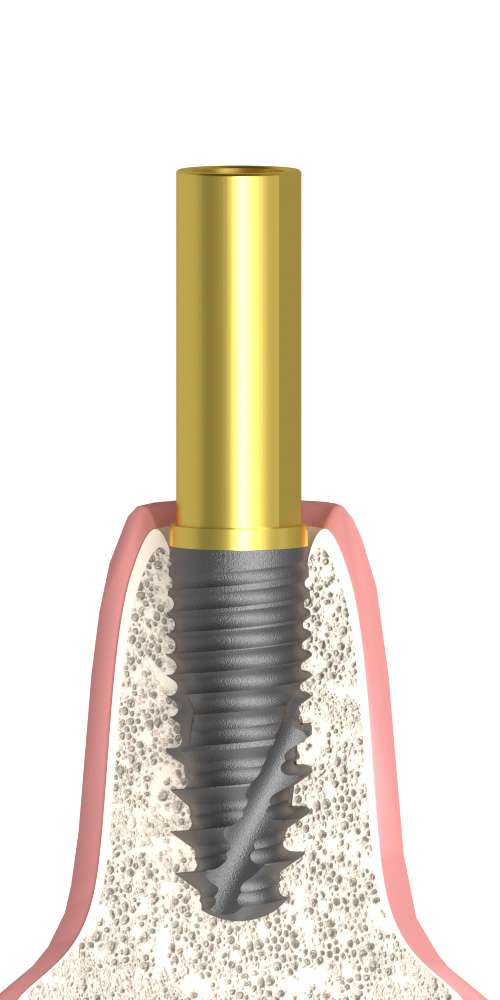 Implant Direct® InterActive® (ID) Compatible, Tube abutment, implant level, positioned
