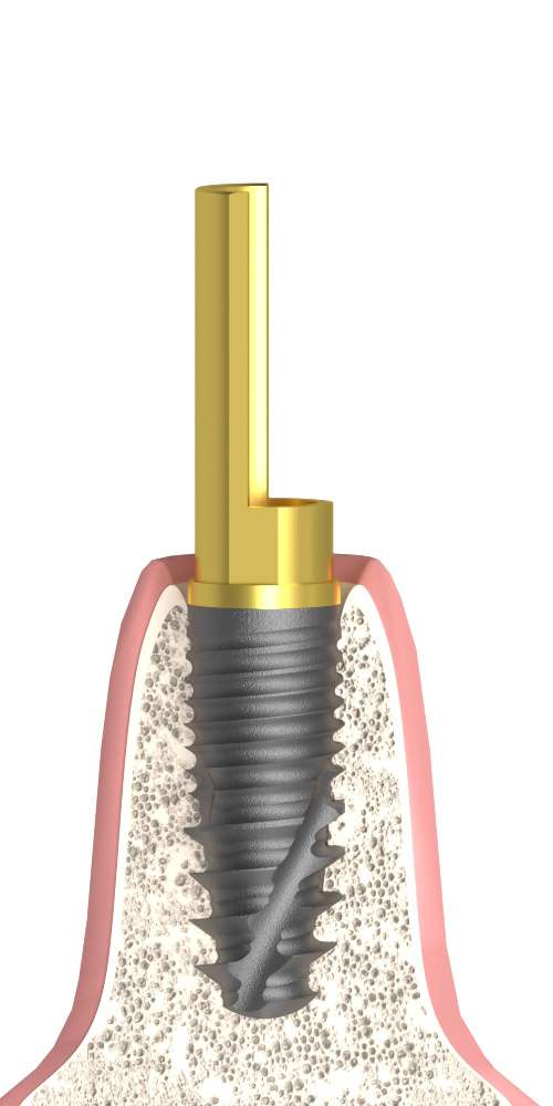 Dentum, Tube abutment, PCT stepped, implant level, positioned
