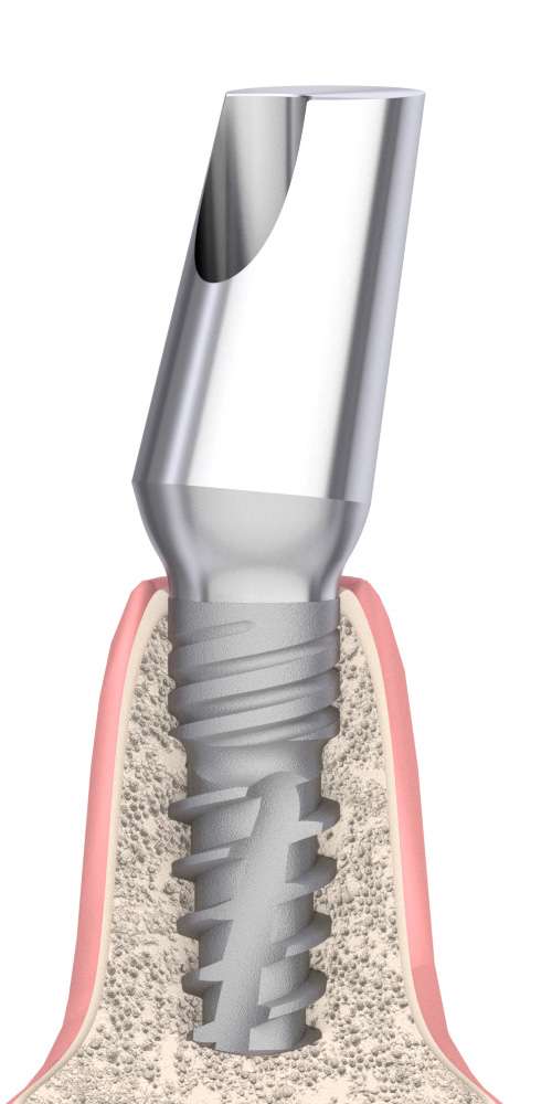 Dentum, Universal abutment, oblique