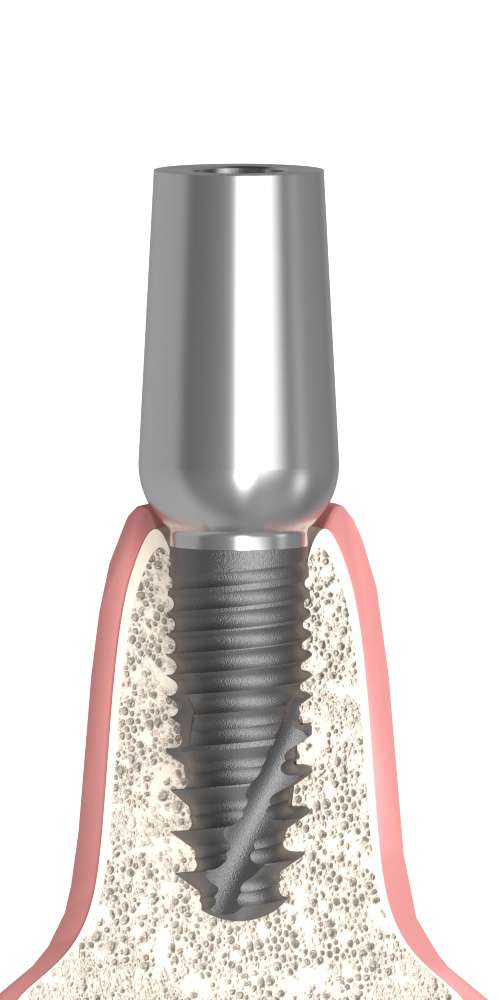 Implant Direct® Replant® (RE) Compatible, Universal abutment, straight