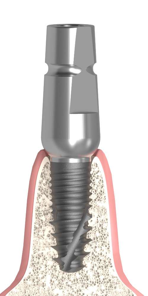Implant Direct® InterActive® (ID) Compatible, Universal abutment, straight, MV
