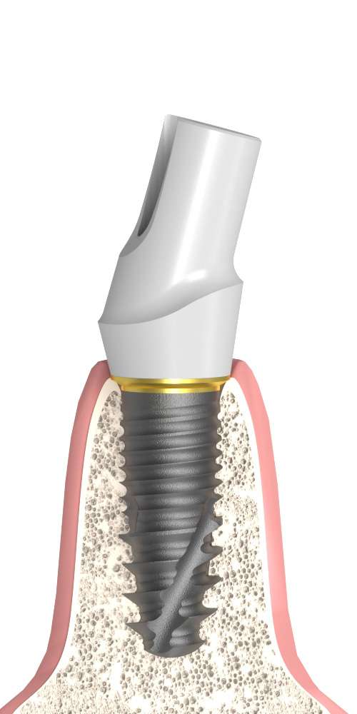 UNIFORM Nobel® Replace® (RP) Compatible, Zircon abutment, with titanium base, oblique, positioned