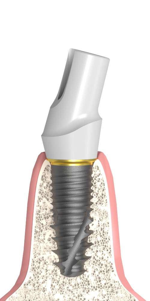 Cosmodent® (CD) Compatible, Zircon abutment, with titanium base, oblique, positioned
